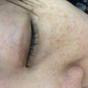 「肝斑」こんなシミ隠れましたコンテスト！デルミサ　レーザーコンシーラーの投稿画像