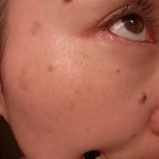 「そばかすが・・・・」こんなシミ隠れましたコンテスト！デルミサ　レーザーコンシーラーの投稿画像