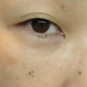 「派手なしみ～～～」こんなシミ隠れましたコンテスト！デルミサ　レーザーコンシーラーの投稿画像