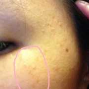 「目の下のシミ・・」こんなシミ隠れましたコンテスト！デルミサ　レーザーコンシーラーの投稿画像