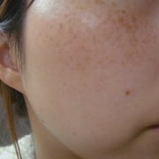 「ひどいそばかす」こんなシミ隠れましたコンテスト！デルミサ　レーザーコンシーラーの投稿画像