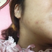 「かなりニキビ跡がひどいので何とかしたいです」頑固なシミを消したい人大募集！デルミサスキンフェイドクリーム＆ローションの投稿画像