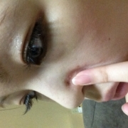 「鼻脇のシミ」頑固なシミを消したい人大募集！デルミサスキンフェイドクリーム＆ローションの投稿画像