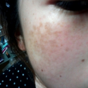 「頬のシミ」頑固なシミを消したい人大募集！デルミサスキンフェイドクリーム＆ローションの投稿画像