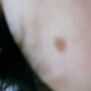 「2箇所」頑固なシミを消したい人大募集！デルミサスキンフェイドクリーム＆ローションの投稿画像