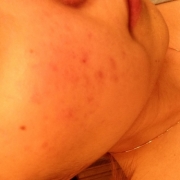 「なおしたい！」気になる顔のニキビ・傷跡に！フランス発の傷跡ケアオイル！の投稿画像