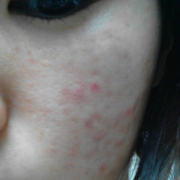 「頬のニキビ跡」気になる顔のニキビ・傷跡に！フランス発の傷跡ケアオイル！の投稿画像