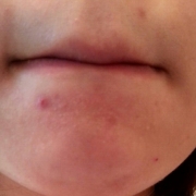 「ニキビ進行中」気になる顔のニキビ・傷跡に！フランス発の傷跡ケアオイル！の投稿画像