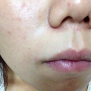 「ニキビの赤み、あとが残る、毛穴」気になる顔のニキビ・傷跡に！フランス発の傷跡ケアオイル！の投稿画像