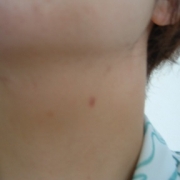 「★首周りと米神のニキビ跡★」気になる顔のニキビ・傷跡に！フランス発の傷跡ケアオイル！の投稿画像