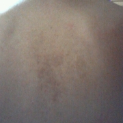 「背中のニキビ跡」気になる顔のニキビ・傷跡に！フランス発の傷跡ケアオイル！の投稿画像