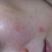 「ニキビを潰した痕です」気になる顔のニキビ・傷跡に！フランス発の傷跡ケアオイル！の投稿画像