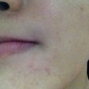 「顔出しＯＫです！」気になる顔のニキビ・傷跡に！フランス発の傷跡ケアオイル！の投稿画像