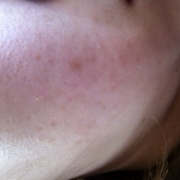 「ニキビ跡」気になる顔のニキビ・傷跡に！フランス発の傷跡ケアオイル！の投稿画像