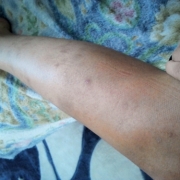 「傷跡」気になる顔のニキビ・傷跡に！フランス発の傷跡ケアオイル！の投稿画像