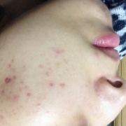 「ニキビ跡」気になる顔のニキビ跡・傷跡に！フランス発のスカーリペアオイル！の投稿画像