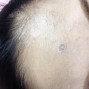 「ニキビ跡」気になる顔のニキビ跡・傷跡に！フランス発のスカーリペアオイル！の投稿画像