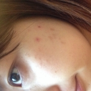 「左頬」気になる顔のニキビ跡・傷跡に！フランス発のスカーリペアオイル！の投稿画像