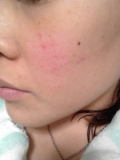 「憎きニキビ痕」の画像（1枚目）