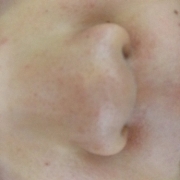 「黒ずみ」顔だしモニター募集　発売前【ニキビケア美容液＆ローション】を10名様に！の投稿画像