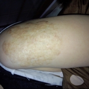 「傷跡」気になる顔のニキビ跡・傷跡に！フランス発のスカーリペアオイル！の投稿画像