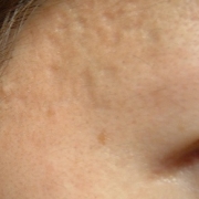 「今思うと後悔。」気になる顔のニキビ跡・傷跡に！フランス発のスカーリペアオイル！の投稿画像