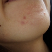 「あごのにきび」気になる顔のニキビ跡・傷跡に！フランス発のスカーリペアオイル！の投稿画像