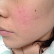 「憎きニキビ痕」気になる顔のニキビ跡・傷跡に！フランス発のスカーリペアオイル！の投稿画像