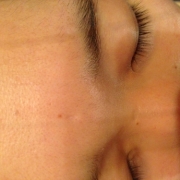 「ニキビ跡」気になる顔のニキビ跡・傷跡に！フランス発のスカーリペアオイル！の投稿画像