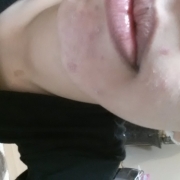 「ニキビ」気になる顔のニキビ跡・傷跡に！フランス発のスカーリペアオイル！の投稿画像