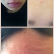 「8年間悩まされてるニキビ」顔だしモニター募集　発売前【ニキビケア美容液＆ローション】を10名様に！の投稿画像