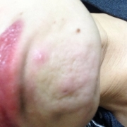 「梅干し」あごのしわの悩みについての声聞かせてください！アンケートに答えるだけ！の投稿画像