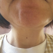 「しわくちゃおばあちゃんにはなりたくない！」あごのしわの悩みについての声聞かせてください！アンケートに答えるだけ！の投稿画像