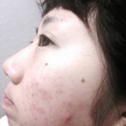 「ニキビ」顔だしモニター募集　発売前【ニキビケア美容液＆ローション】を10名様に！の投稿画像