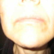 「見えにくいですが」顔だしモニター募集　発売前【ニキビケア美容液＆ローション】を10名様に！の投稿画像