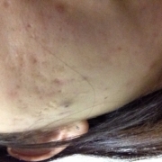 「ニキビがひどいです。」顔だしモニター募集　発売前【ニキビケア美容液＆ローション】を10名様に！の投稿画像