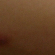 「ニキビが・・・」顔だしモニター募集　発売前【ニキビケア美容液＆ローション】を10名様に！の投稿画像