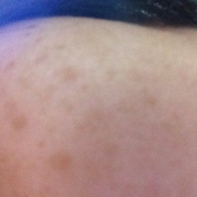 「左頬あたり」来年夏発売予定！純ハイドロキノン配合美容液モニター大募集！の投稿画像