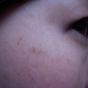 「たくさん・・・」来年夏発売予定！純ハイドロキノン配合美容液モニター大募集！の投稿画像