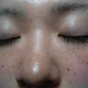 「シミそばかす」来年夏発売予定！純ハイドロキノン配合美容液モニター大募集！の投稿画像