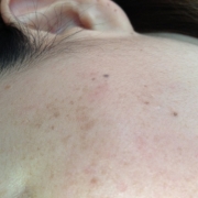 「頬の憎きシミ！」来年夏発売予定！純ハイドロキノン配合美容液モニター大募集！の投稿画像