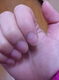 爪の剥がれ、ささくれ。