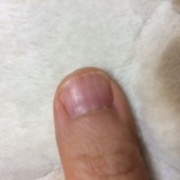 「凸凹、縦割れ」爪が薄い、割れる、でこぼこに！フランス発のネイルエッセンス現品モニター募集の投稿画像