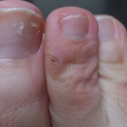 「足の爪です」爪が薄い、割れる、でこぼこに！フランス発のネイルエッセンス現品モニター募集の投稿画像