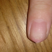 「ハイポニキウムむき出しで割れることが多いです」爪が薄い、割れる、でこぼこに！フランス発のネイルエッセンス現品モニター募集の投稿画像