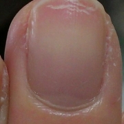 「柔くなってきた爪」爪が薄い、割れる、でこぼこに！フランス発のネイルエッセンス現品モニター募集の投稿画像