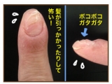 「爪の生え際が整いました。」の画像（1枚目）