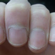 「恥を忍んで」爪が薄い、割れる、でこぼこに！フランス発のネイルエッセンス現品モニター募集の投稿画像