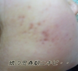 親子で悩むニキビ・・・