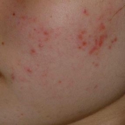 「アクネクリアローション・AZセラム」薬用ニキビケア【アクネル アクネクリアローション＋AZセラム】を20名様に！の投稿画像